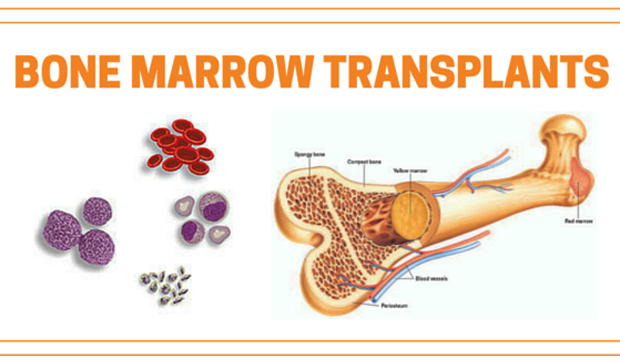 bone-marrow-transplant-feasible-for-adults-with-sickle-cell